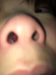 鼻孔出血的原因 鼻孔出血的原因 鼻孔出血 教你如何处理它