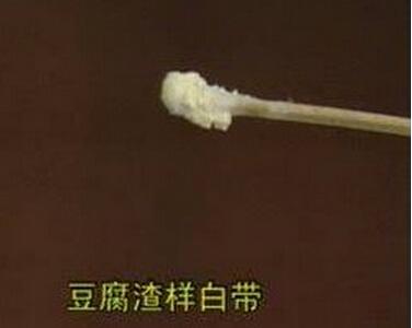 下身瘙痒有豆腐渣 下面痒还有豆腐渣是怎么回事？