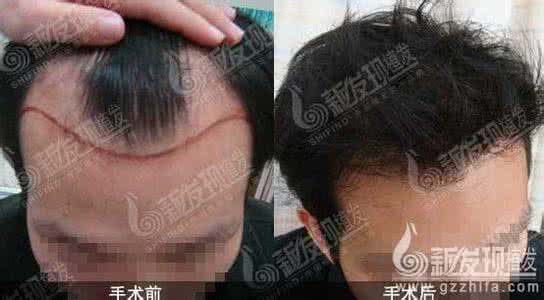 男性脱发的原因有哪些 男性脱发的原因主要有哪些