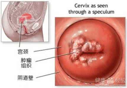 女性宫颈囊肿的治疗 女性的宫颈处有囊肿怎么办?
