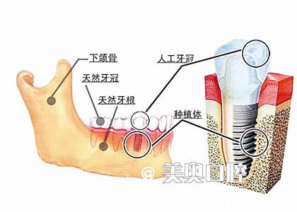种植牙对身体有害吗 种植牙对身体有害吗 种植牙对人体有害吗？