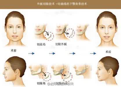 拔智齿能瘦脸吗 拔智齿可以瘦脸吗 拔智齿能瘦脸吗？揭秘五大瘦脸术