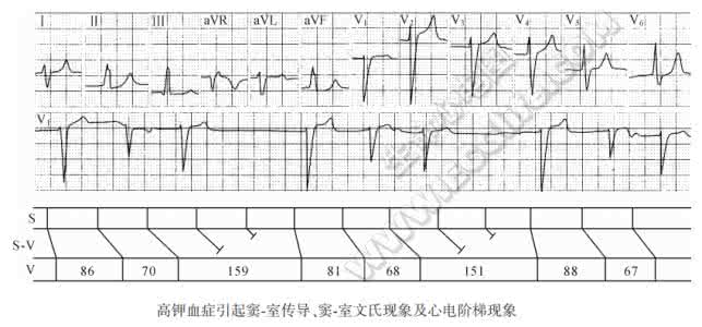 窦房传导阻滞心电图 高钾血症心电图 高钾血症引起窦室传导、窦室文氏现象及心电阶梯现象心电图精解