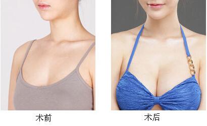 自体活细胞丰胸多少钱 自体活细胞丰胸多少钱 自体活细胞丰胸效果真的那么好?