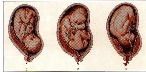 前置胎盘怎样可以上移 前置胎盘怎么办