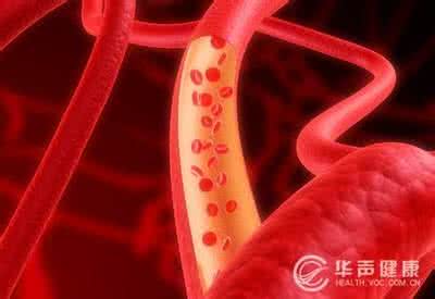 肝血管瘤会影响寿命吗 呵护血管健康 延长您的寿命