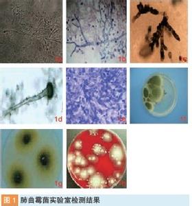 霉菌感染的治疗方法 霉菌感染 霉菌感染的检查方法