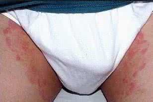 大腿肚内侧股癣症状 大腿肚内侧疼 五个原因造成这种症状