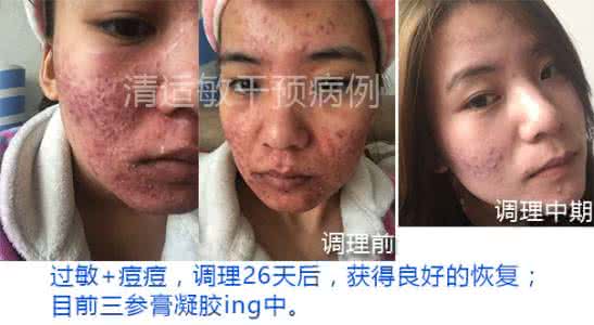 中医去除痤疮 中医去除痤疮 去除痤疮 中医方法帮你去除痤疮