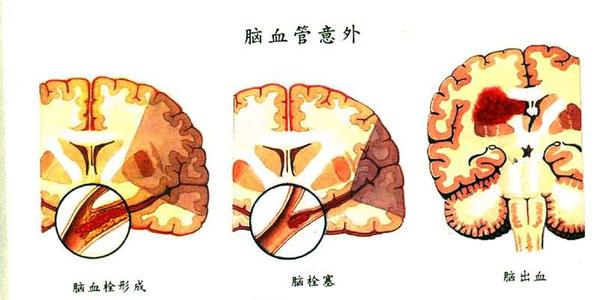 脑萎缩最佳治疗方法 偏方大全*脑萎缩篇