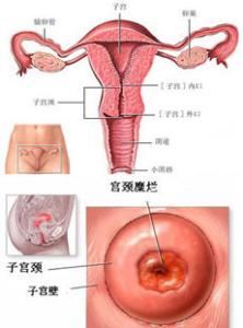 宫颈糜烂的形成原因 宫颈糜烂形成的原因是什么？