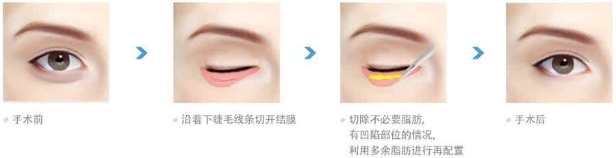 去除眼袋手术的价格 去除眼袋手术的价格 去眼袋手术的价格