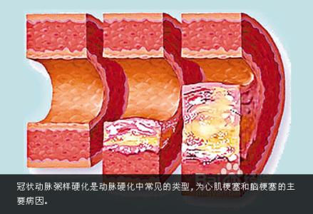 动脉硬化怎么治疗 妙药奇方治动脉硬化