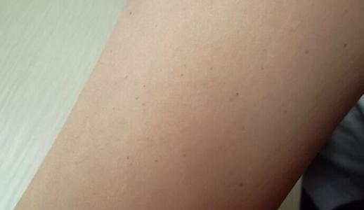 白殿疯会不会传染 春季要警惕牛皮癣 牛皮癣会不会传染