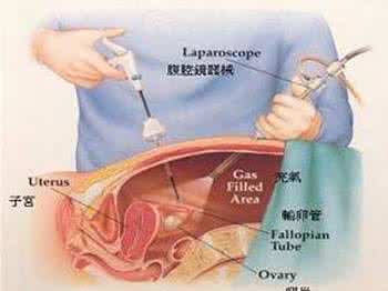 输卵管结扎手术视频 何时可做输卵管结扎手术?
