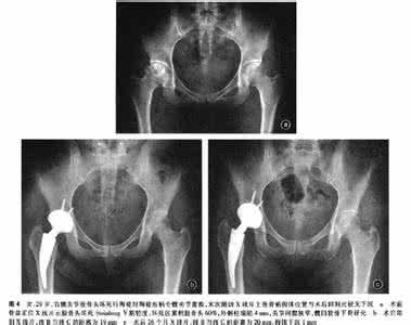 股骨头坏死髋关节置换 髋关节置换前CT和X射线检查预测坏死股骨头的塌陷：单中心、开放性、诊断性试验_图文