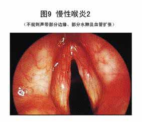 怎样治疗慢性咽炎 慢性咽炎怎样治疗 治疗慢性咽炎注意这5点
