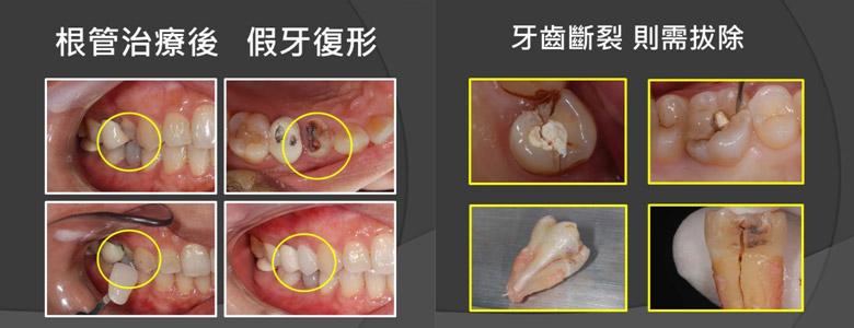 根管治疗后牙疼 根管治疗后可以喝茶吗 喝茶可以治疗白癜风吗？