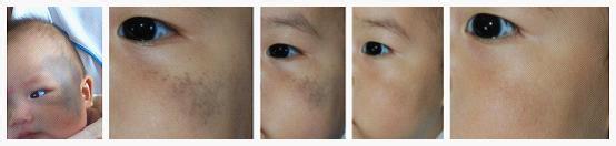 太田痣什么年龄最适合 做太田痣哪里比较好 多大年龄治疗太田痣效果较好？