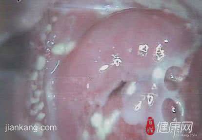 根治霉菌性阴炎的方法 霉菌性阴炎怎么根治 让女人们变得轻松