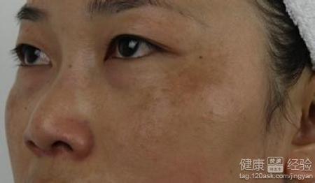 黄褐斑是怎么形成的 黄褐斑怎么形成的 黄褐斑的形成，黄褐斑是怎么形成的