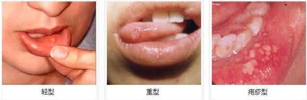 口腔溃疡食疗方 口腔溃疡吃什么好 口腔溃疡吃什么好 五款食疗方告别溃疡