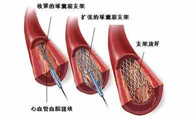 早期冠心病如何治疗 冠心病介入治疗  怎么治疗冠心病