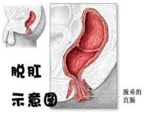 脱肛初期症状 脱肛的症状