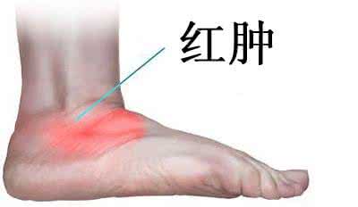 肌腱炎能自愈吗 肌腱炎的症状