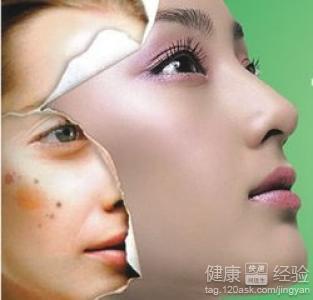 去黄褐斑最有效的方法 美容护肤 去黄褐斑最有效的方法 让你远离黄褐斑