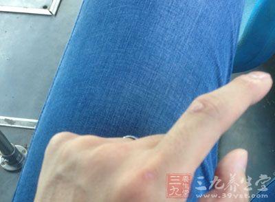 骨肉瘤的早期症状 骨肉瘤症状 什么是骨肉瘤以及骨肉瘤的治疗
