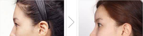 额头凹陷怎么填充 额头中间凹陷 人体额头凹陷的解决方法