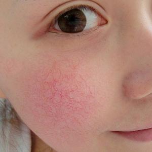 脸部红血丝怎么办 脸部红血丝 脸部红血丝怎么办