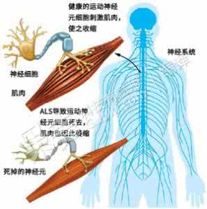 als患者 als患者 一个神经内科医生眼中的ALS_als患者