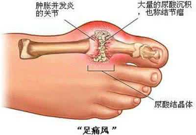 痛风安十五味乳鹏丸 痛风只要血行气和，其病自安，效方治疗告别痛风