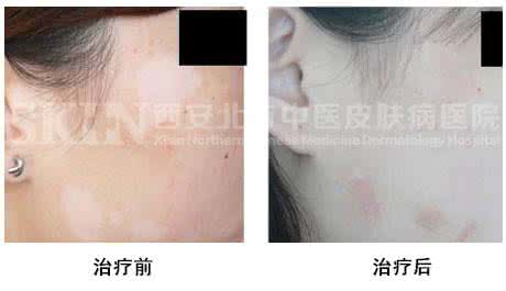 西安宫颈白斑治疗 西安宫颈白斑治疗 宫颈白斑应如何治疗