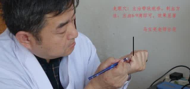 一次性三棱针 蛇盘疮很痛苦、三棱针一次除!