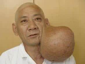 腮腺混合瘤 腮腺混合瘤 腮腺肿瘤