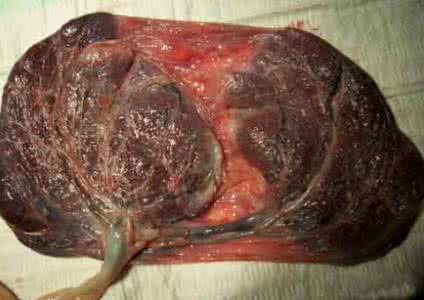 胎盘后壁 胎盘后壁 胎盘后壁离刀口远么？