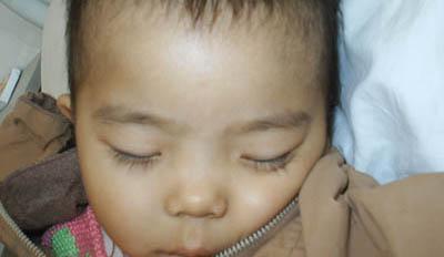 地中海贫血患者症状 贫血症状表现 贫血的症状 贫血患者都有哪些症状表现