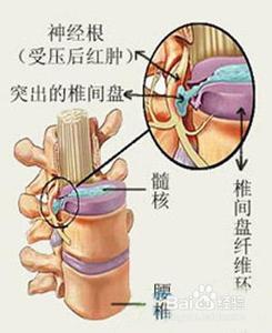 治疗颈椎病最好方法 颈椎病类型 颈椎病有什么表现？颈椎病的类型？