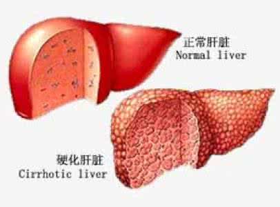 肝硬化可以活多久 这种病拖久了容易变成肝硬化 得赶紧治