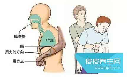 气管呛入异物怎么办 气管呛入异物怎么办？
