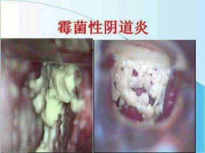 霉菌性阴倒炎能自愈吗 霉菌性阴炎怎么引起的 霉菌性阴炎传播方式