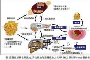 非酒精性脂肪性肝病 非酒精性脂肪性肝病 非酒精性脂肪肝病 是什么导致了病症的爆发