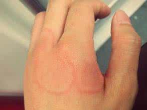 荨麻疹诱因 慢性荨麻疹注意事项 慢性荨麻疹的诱因和治疗 注意