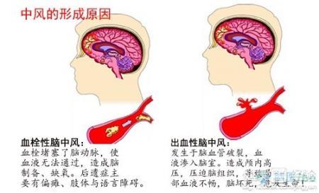 哈欠连天与脑血栓 脑血栓征兆 哈欠不断 突发头晕 流鼻血 出现这些征兆警惕脑血栓来袭