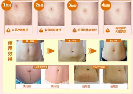 怎么彻底去除妊娠纹 妊娠纹怎么去除？掌握3大步骤轻松去除
