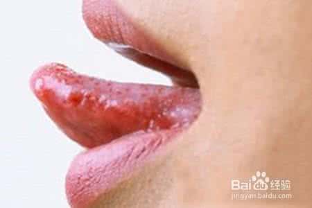 舌尖红有心火如何去除 心火大怎么去除?