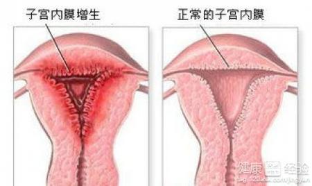 子宫内膜薄吃什么好 子宫内膜薄吃什么好 子宫内膜薄吃这些好